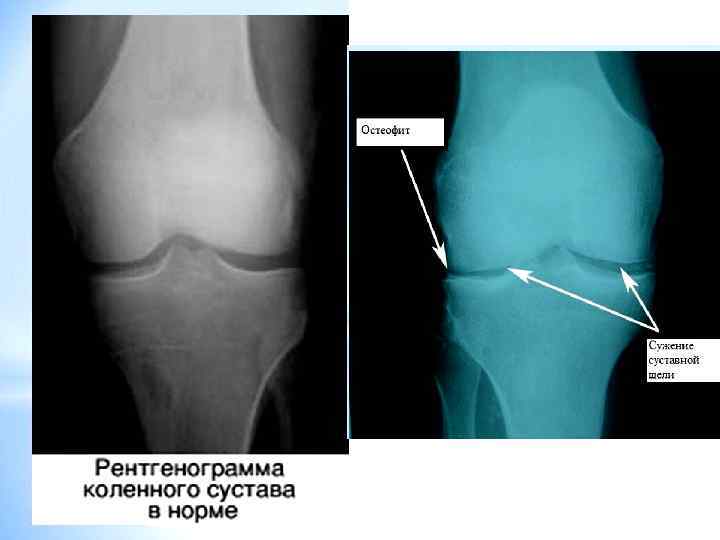 Осторожно Артроз! Введение. - Бодибилдинг форум AnabolicShops